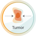Tumor image